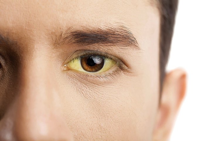 yellow eyeballs causes
