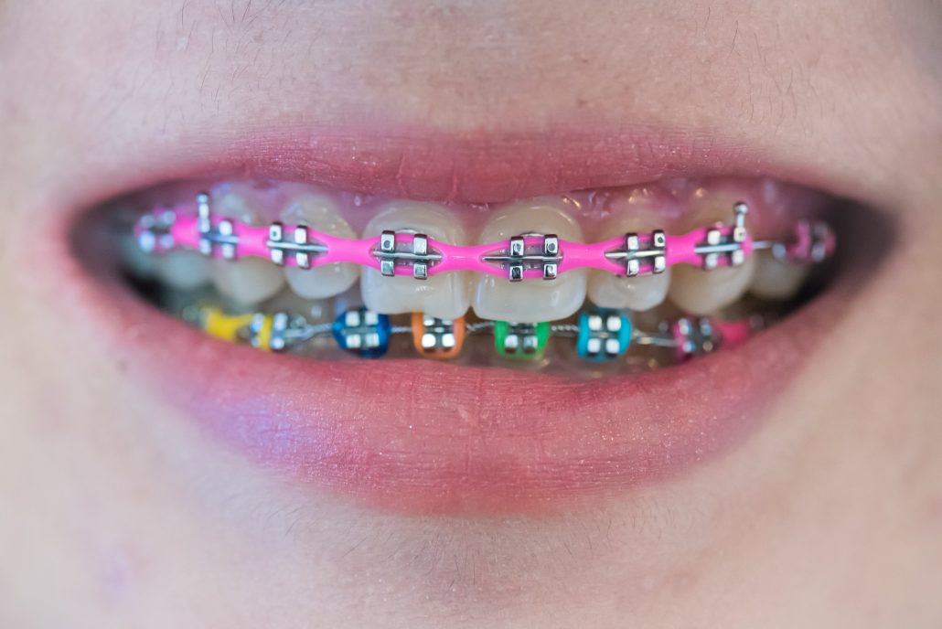 Colourful rubber bands used for braces