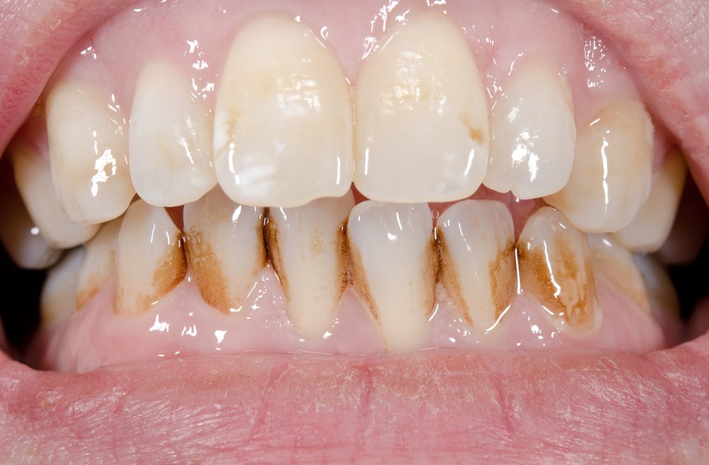 Do You Have Yellow Teeth? Know What Causes It