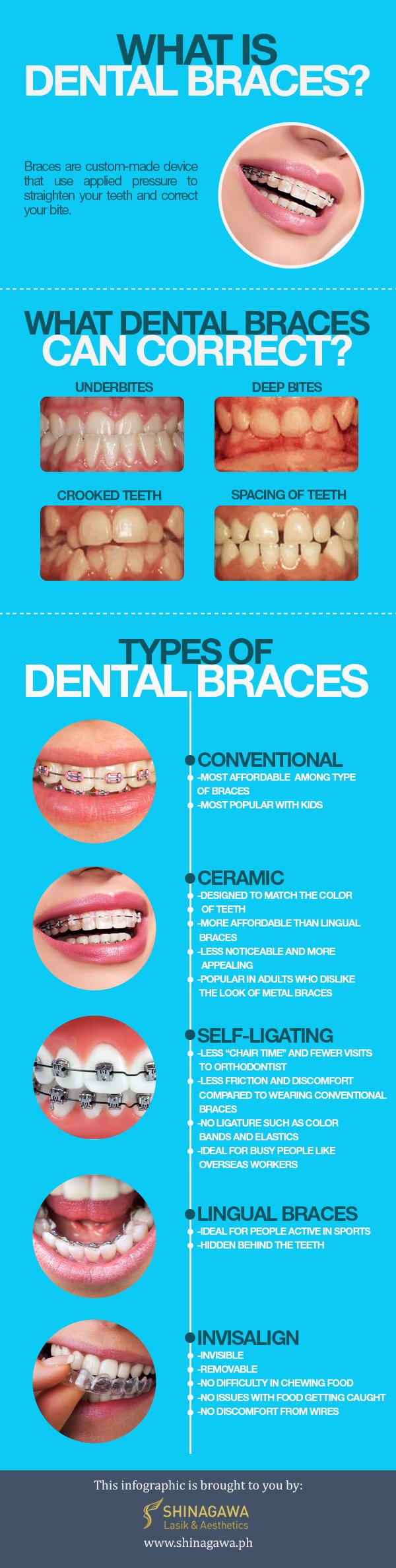 What is Dental Braces by Shinagawa.ph