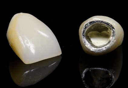 Porcelain-fused-to-metal (PFM) Teeth