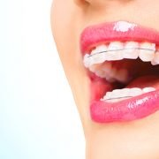 What Ceramic Braces Can Do For You