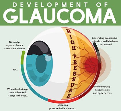 Glaucoma Philippines