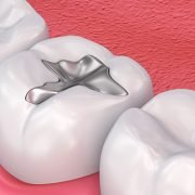 What Dental Filling Can Do For Your Teeth