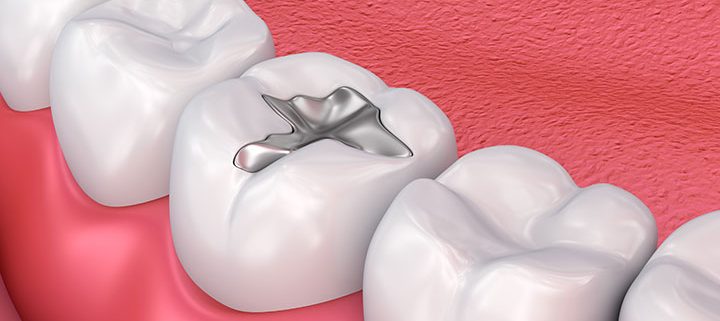 What Dental Filling Can Do For Your Teeth