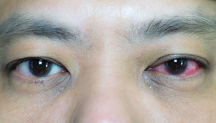 Causes of Red Eyes