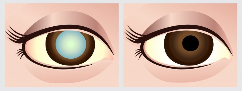 Representation of Before and After Cataract Surgery