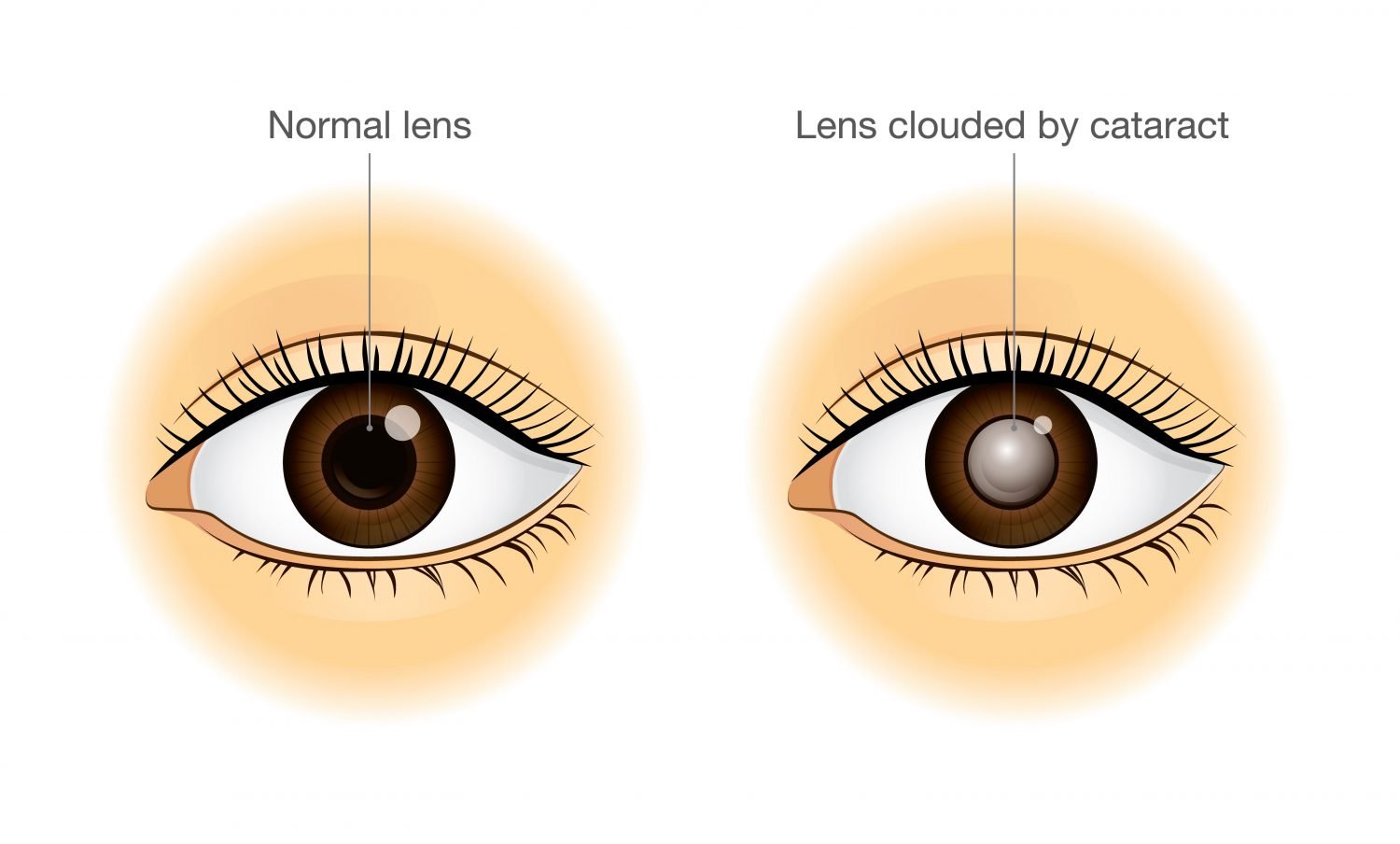 Comparison of Normal Lens and Lens clouded by Cataract