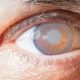 Eye With Cataract