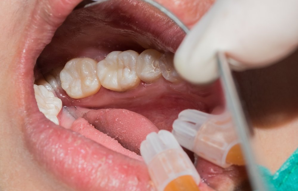 Why Do You Need Dental Filling?