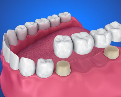 Representation of Dental Bridges and Crowns