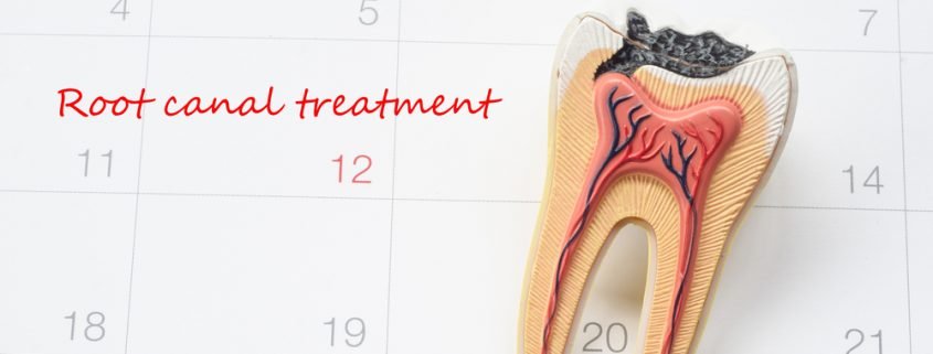 Save Your Tooth through Root Canal Treatment