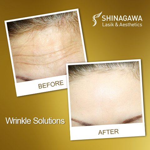 Wrinkle Solutions: Botulinum Toxin for Facial Wrinkles