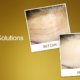 Wrinkle Solutions: Botulinum Toxin for Facial Wrinkles | Promos & Offers