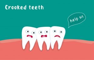 Knowing if your Teeth are Crooked or your Bite is Misaligned 2