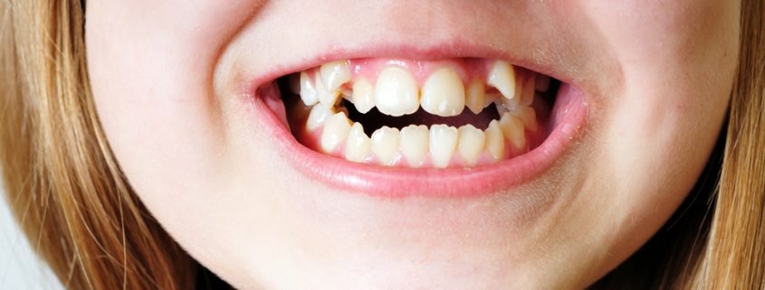 Knowing if your Teeth are Crooked or your Bite is Misaligned 1