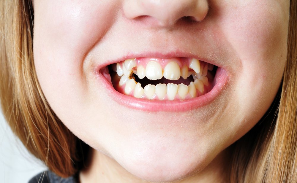 Knowing if your Teeth are Crooked or your Bite is Misaligned 1