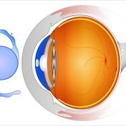 What Are The Differences Of IOLs In Cataract Surgery?