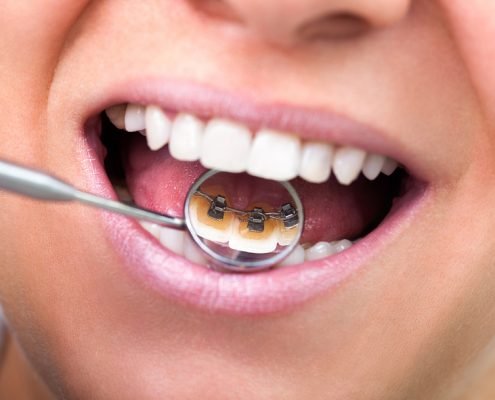 Lingual Braces for Shinagawa Orthodontics Blog