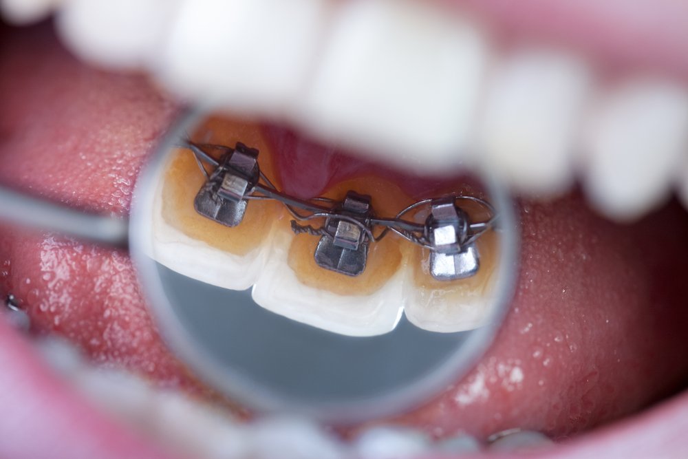 Taking Care Of Your Lingual Braces