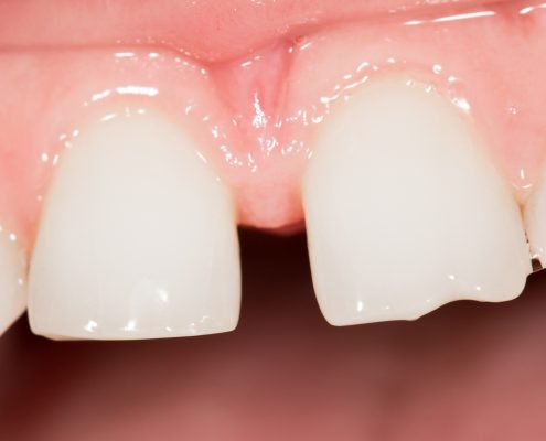 Causes of Gapped Teeth 2