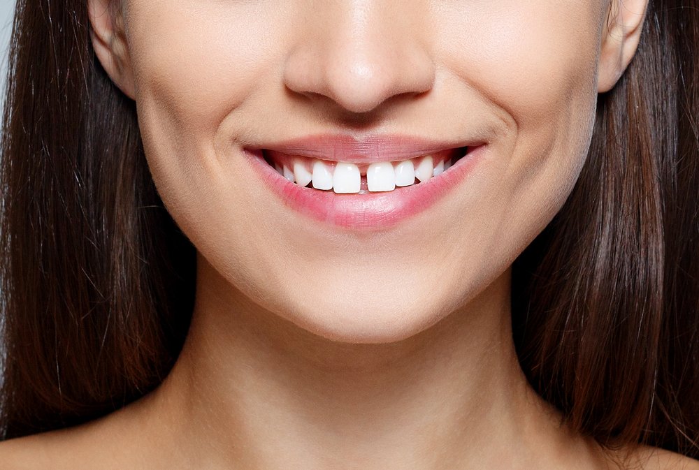 Causes of Gapped Teeth 1
