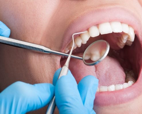 Making Teeth Whitening Results Last 2 | Shinagawa Orthodontics Blog