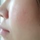 Treating Enlarged Pores | Shinagawa Derma Blog