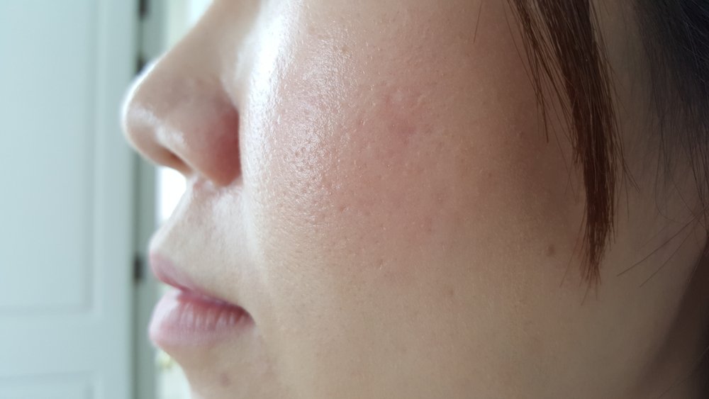 Treating Enlarged Pores | Shinagawa Derma Blog
