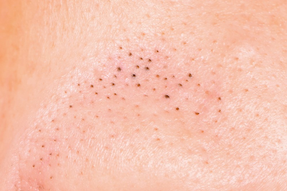 Ways To Prevent And Effectively Treat Blackheads.