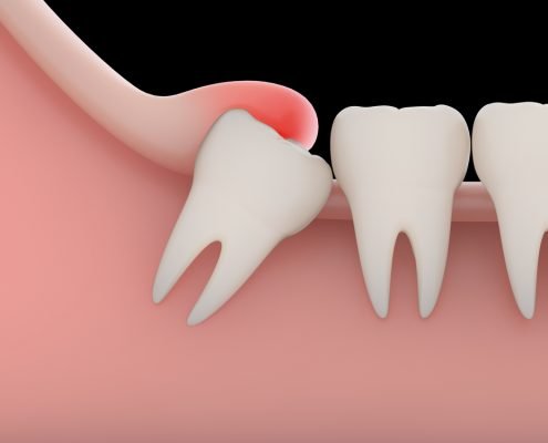 Impacted Tooth 1 | Shinagawa Orthodontics
