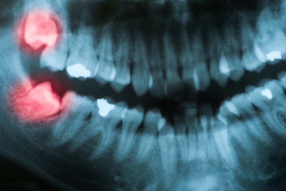 Symptoms Of Impacted Wisdom Tooth