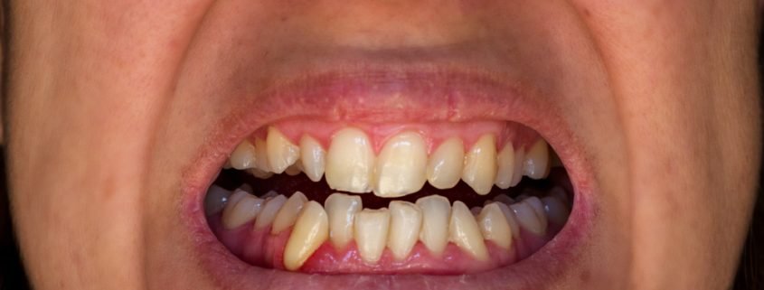 Causes of Crooked Teeth
