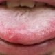 The Importance Of Cleaning Your Tongue | Shinagawa Dental Blog
