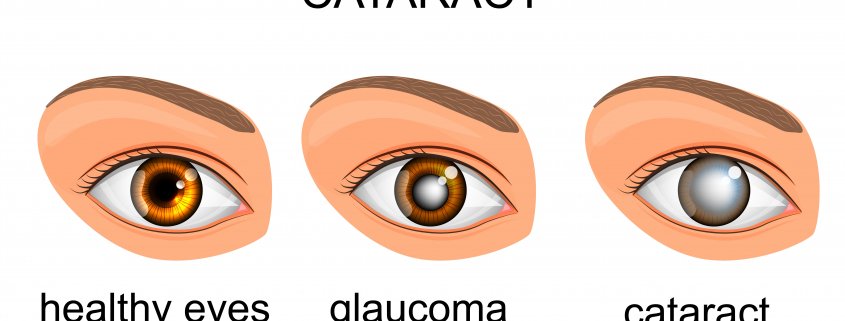 Differences Between Cataract And Glaucoma | Shinagawa Cataract Blog