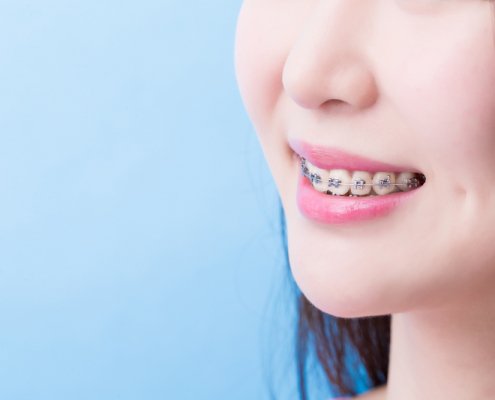 Can Braces Improve The Shape Of Your Face | Shinagawa Dental Blog