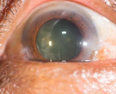 Eyes With Cataracts | Shinagawa Cataract Blog