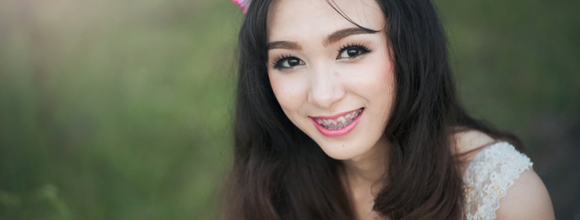 How Braces Improve Your Smile | Shinagawa Dental Blog