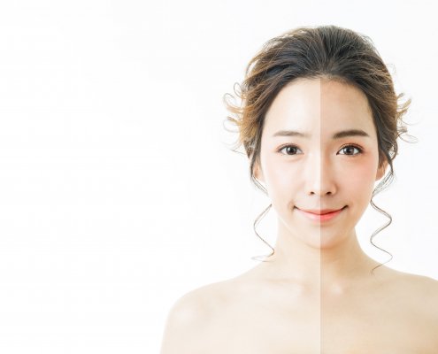 This The Season To Be Hair and Blemish-Free Skin | Shinagawa Aesthetics Blog