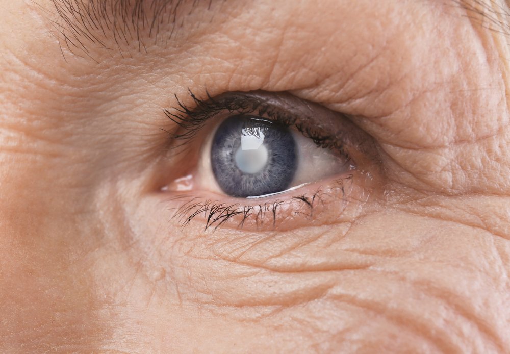What Happens With Untreated Cataracts | Shinagawa Cataract Blog