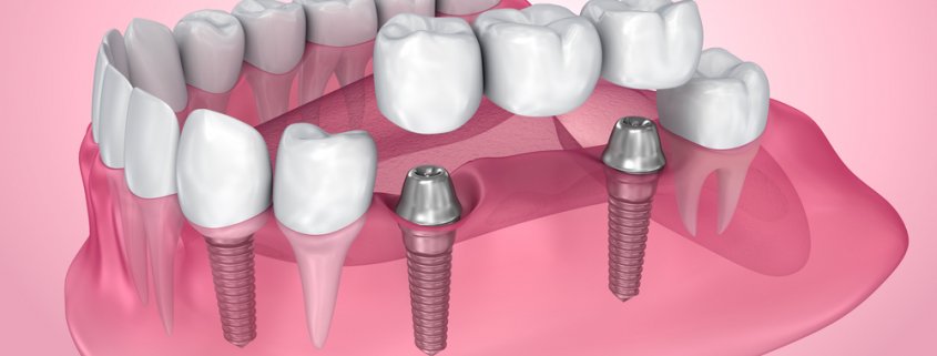 Advantages That Dental Bridges Can Give | Shinagawa Dental Blog