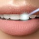 Post Care Musts After Laser Teeth Whitening | Shinagawa Dental Blog