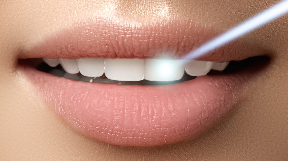 Post Care Musts After Laser Teeth Whitening | Shinagawa Dental Blog