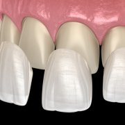 Rebuilding Your Smile With Porcelain Veneers | Shinagawa Dental Blog