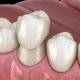 Dental Crown For Your Damaged Tooth | Shinagawa Dental Blog
