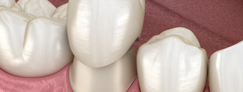 Dental Crown For Your Damaged Tooth | Shinagawa Dental Blog