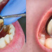 Effective Tips For Preventing Plaque | Shinagawa Dental Blog