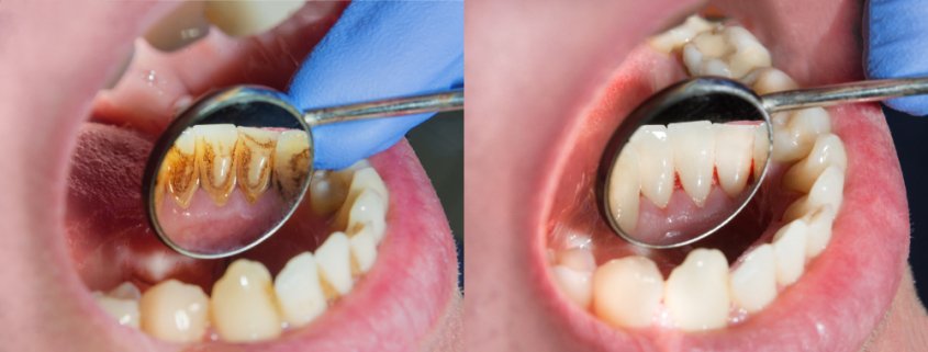 Effective Tips For Preventing Plaque | Shinagawa Dental Blog
