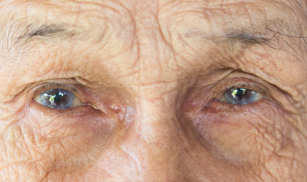 The Changes In Your Vision Due To Cataract | Shnagawa Cataract Blog