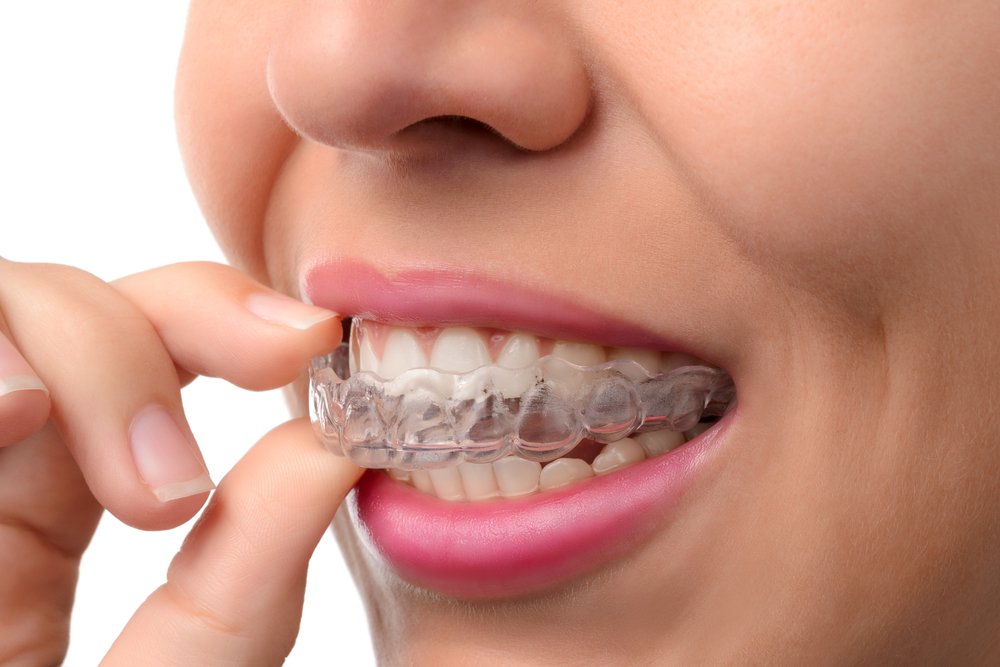 Things You Need To Know About Invisalign | Shinagawa Dental Blog